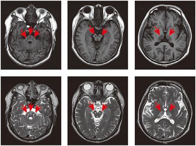 Case report: Episodic psychosis caused by a novel SCP2 splicing mutation
